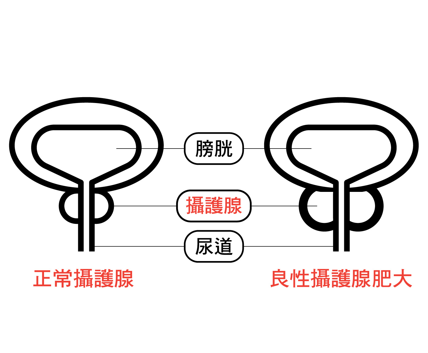 攝護腺肥大飲食建議-02 攝護腺肥大飲食建議-02